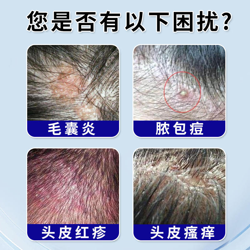 毛囊炎头皮瘙痒红疹红疙瘩脂溢性皮炎专用头上后背脸上手臂长痘痘-淘宝网