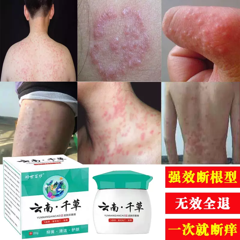 皮肤干燥瘙痒百草膏湿疹止痒抑菌狼毒湿毒清软膏 皮肤干燥瘙痒百草膏湿疹止痒抑菌狼毒湿毒清软膏