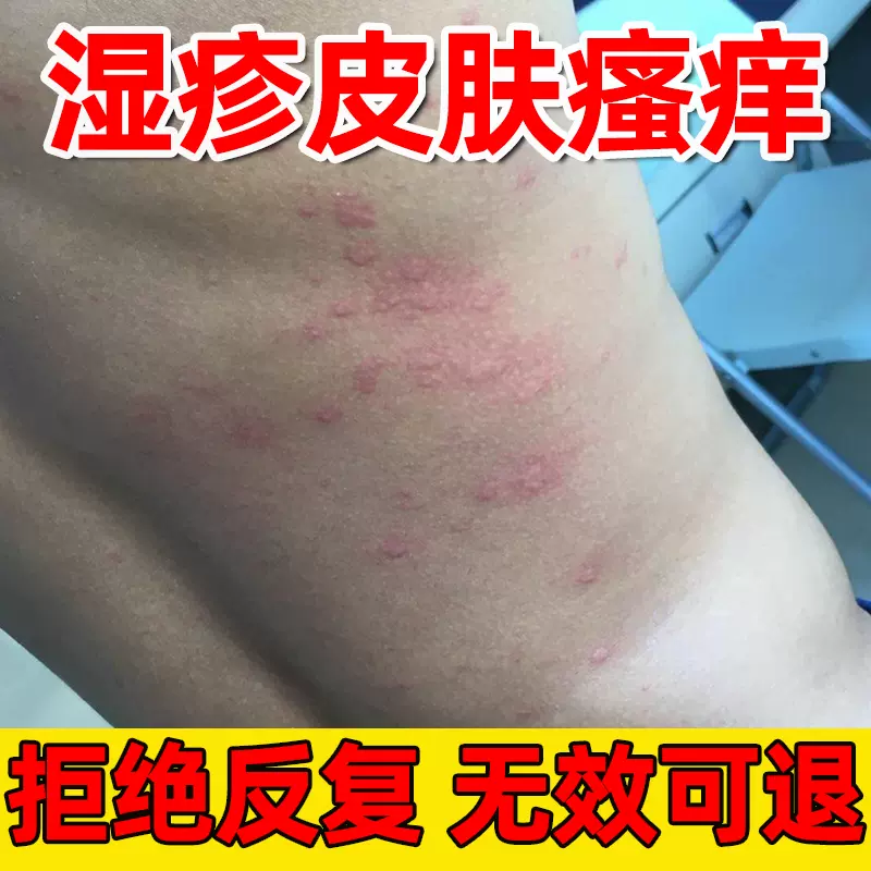 癣立净真菌克星湿疹止痒去根干燥皮肤瘙痒止痒抑菌全身痒外用药膏 Taobao