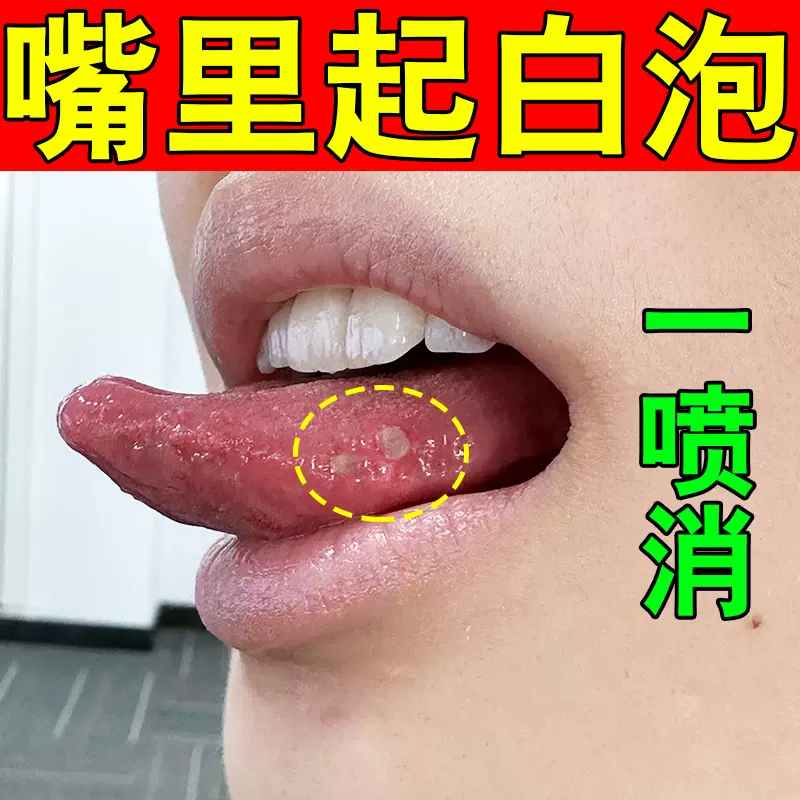 口腔上火嘴巴舌头烂口腔内壁起泡白点嘴防破疼痛养护粘膜止痛喷剂-Taobao