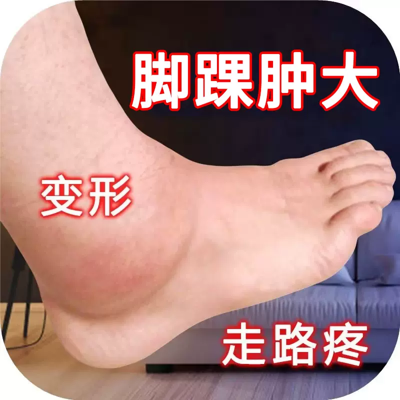脚腕疼痛专用脚踝关节酸痛积液肿胀崴脚扭伤脚脖子走路