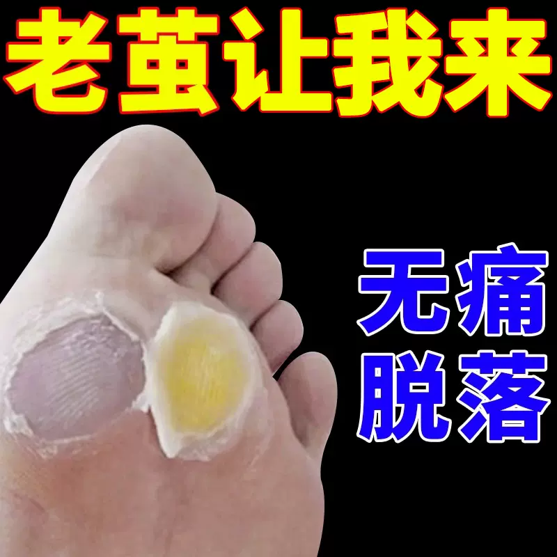 清繭靈去死皮老繭手關節繭腳上腳墊肉繭