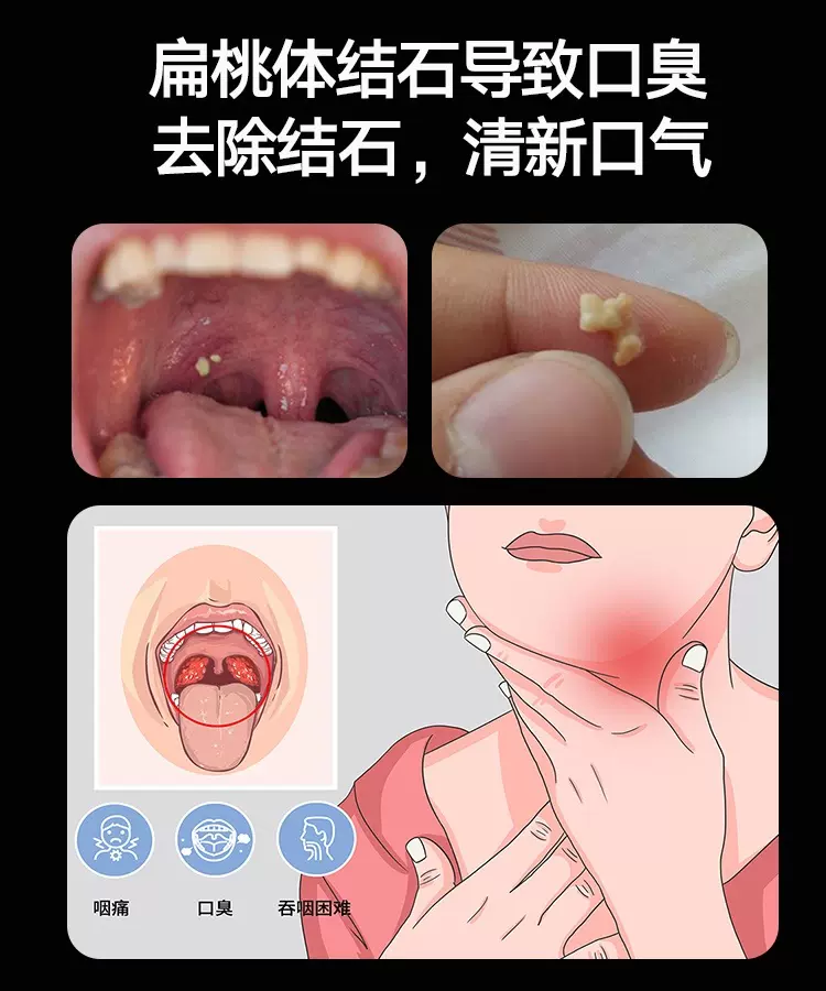 扁桃体结石去除工具喉咙污垢颗粒清理神器口腔冲洗器漱口水去口臭