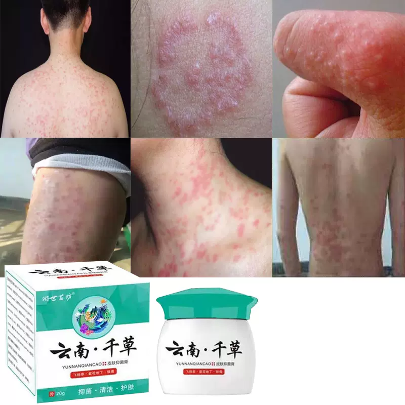 皮肤干燥瘙痒百草膏湿疹止痒抑菌狼毒湿毒清软膏正品草本小乳药膏 Taobao