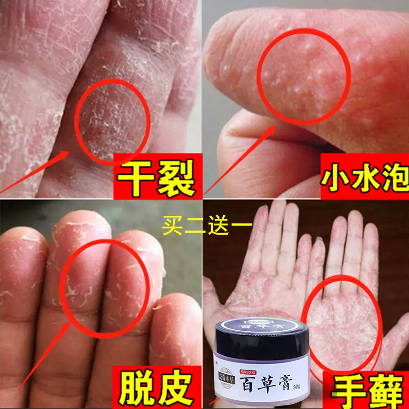 手癣膏手足癣湿疹止痒真菌感染治疗汗疱疹脱皮干裂水泡藓药膏手气-Taobao