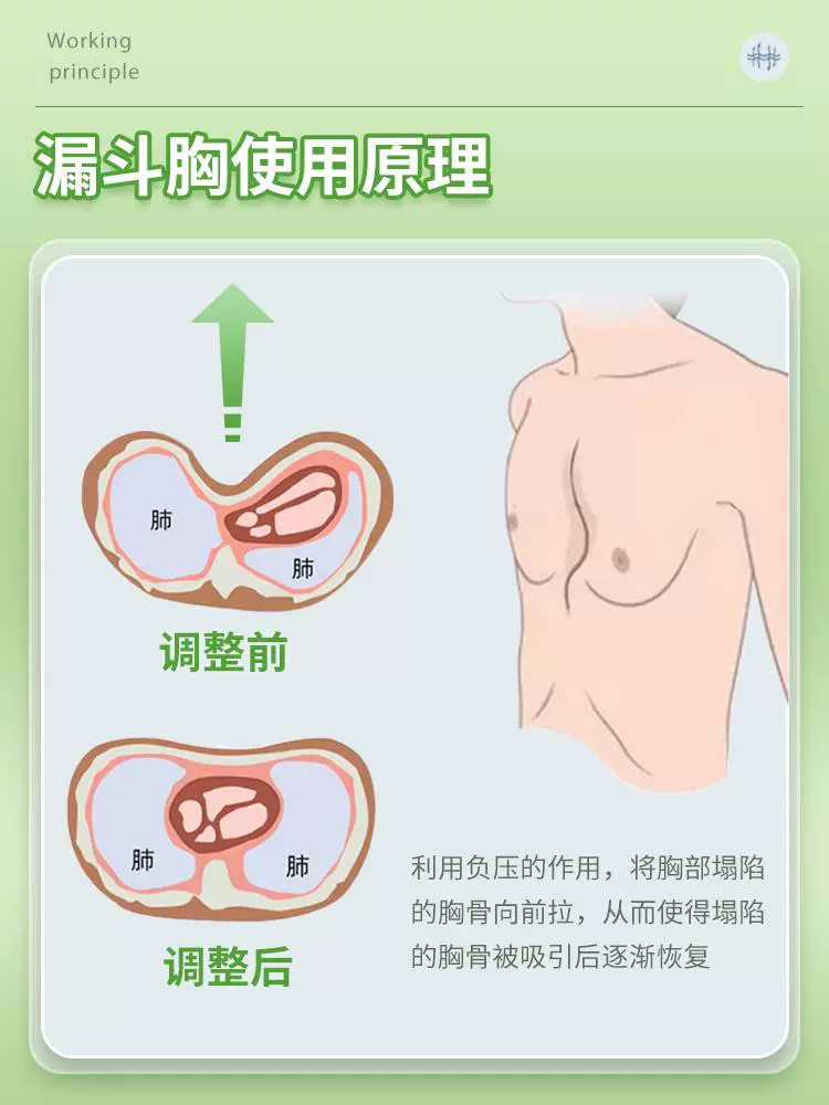 ペクタクエッグ 漏斗胸矯正器具 - 矯正用品・補助ベルト