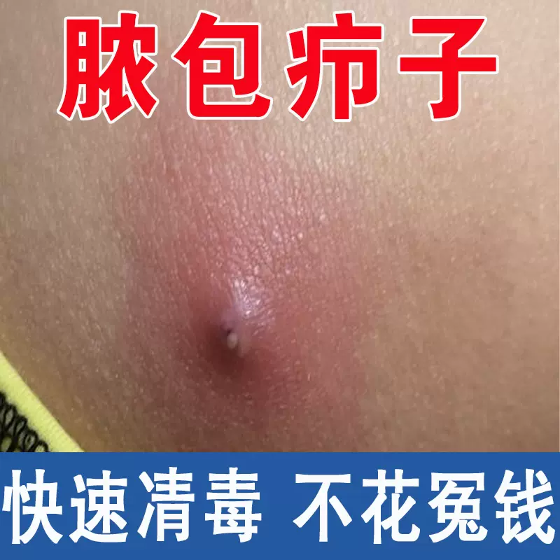 疖子