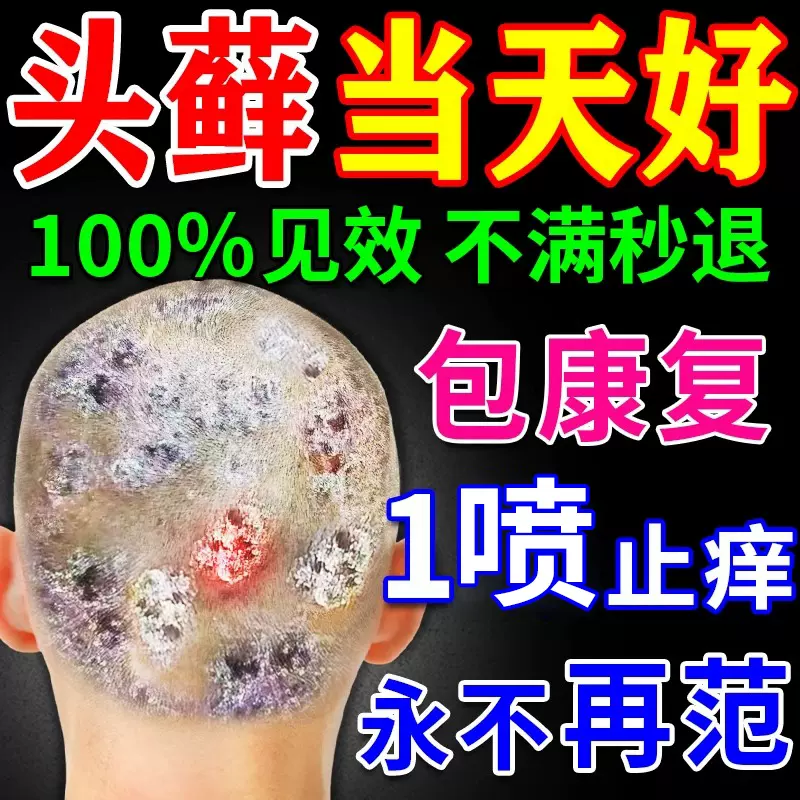 脂溢性皮炎头皮治疗
