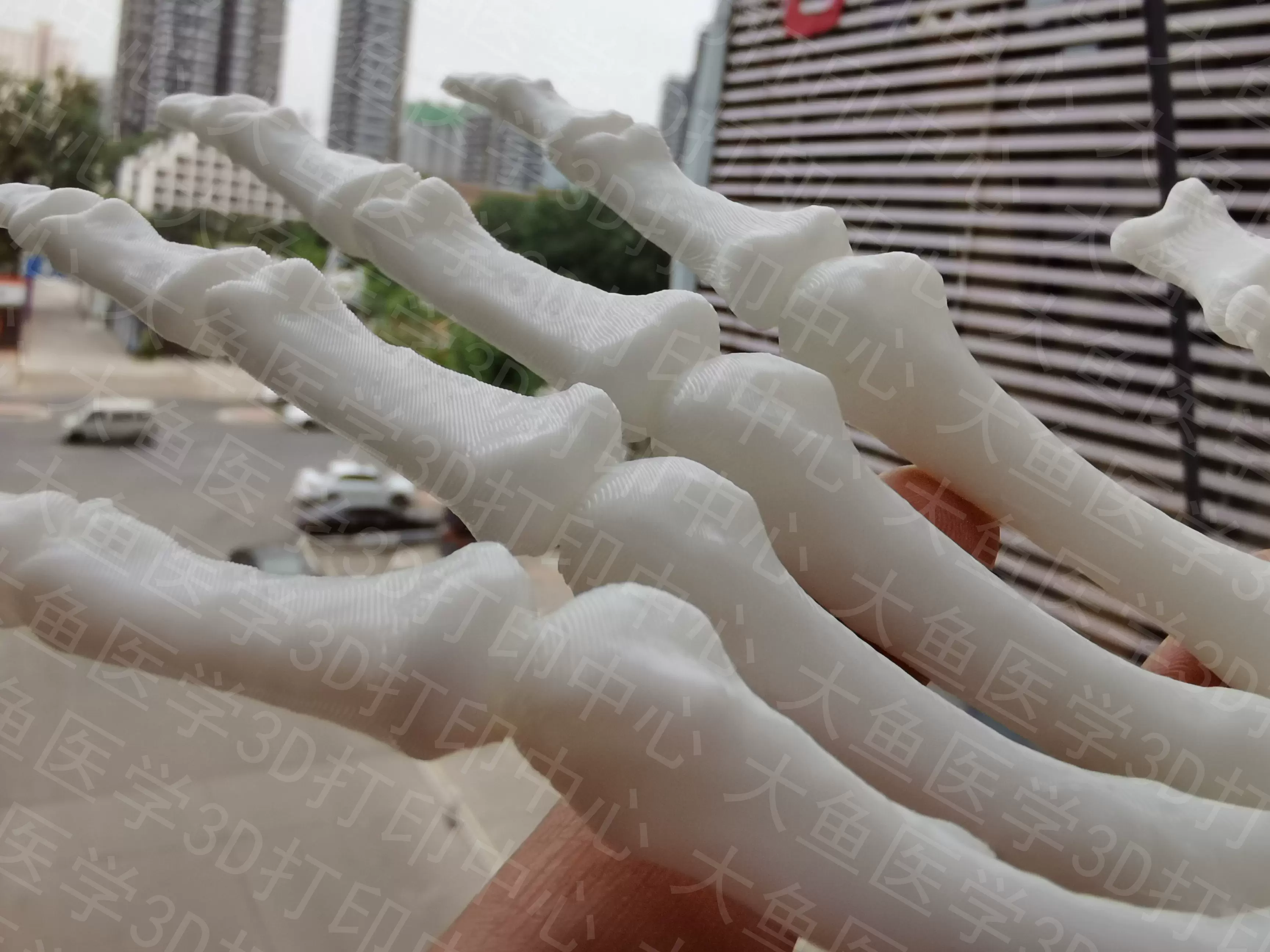 手脚骨断指再造手掌骨修复手外科骨折工伤跟骨距骨腓骨